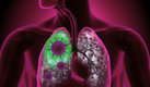 Los pulmones pueden dejar de oxigenar la sangre en los casos más graves de COVID. (Google)