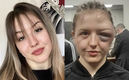 Cheyenne "Pepper" Hanson mostró cómo quedó del rostro.