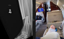 La fractura antes de la cirugía y en el avión de regreso a casa.