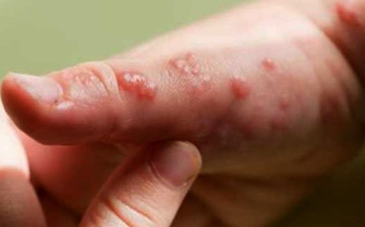 La viruela del mono sigue en aumento en Europa.