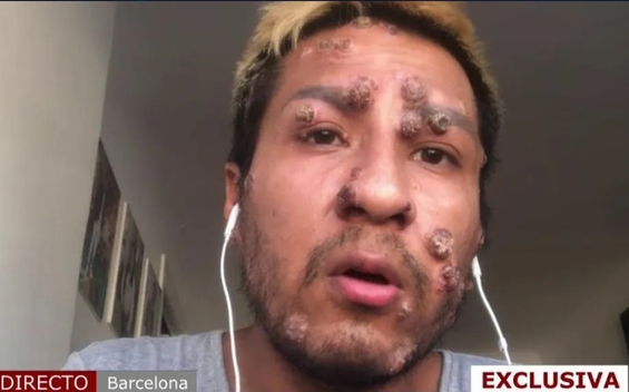 Marcas de Viruela de Mono / Cuatro al día