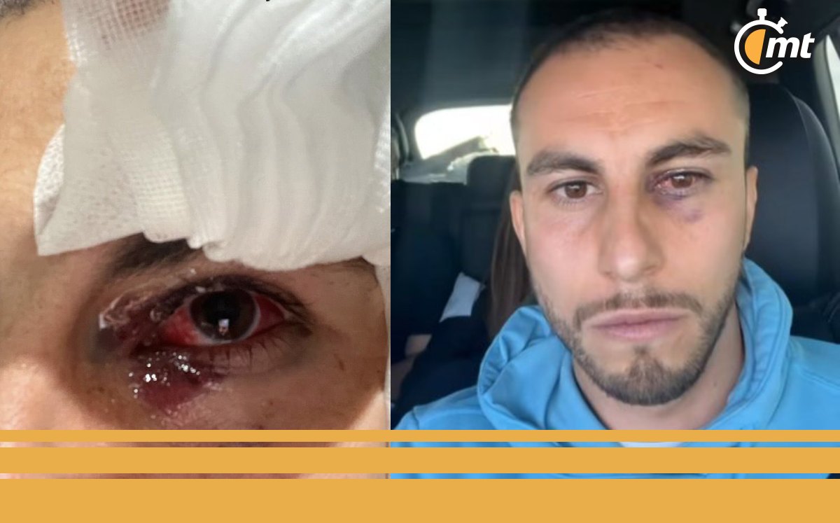 El necaxista mostró en redes sociales el resultado del golpe del americanista (Captura)