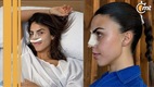 Influencer llora por su rinoplastia