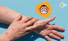 Conoce los síntomas de la viruela del mono
