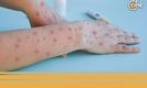 Confirman aumento de casos de Mpox en México; cómo identificar síntomas