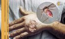 ¿Qué es Leishmaniasis, enfermedad que se da por picadura de mosquito?
