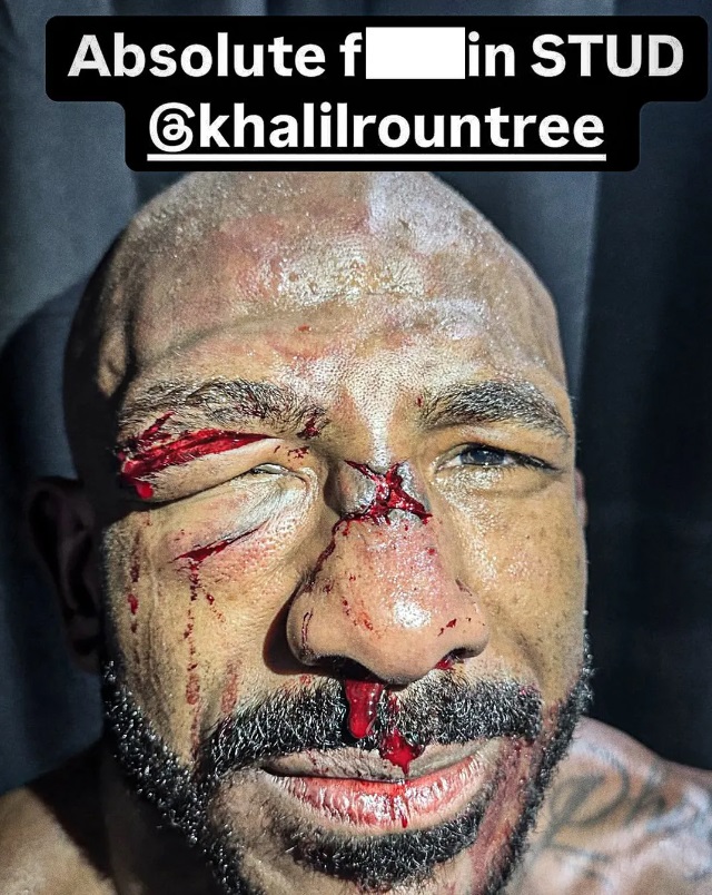 Así quedó la nariz y rostro de Khalil Rountree tras pelea contra Alex Pereira. Foto: TMZ
