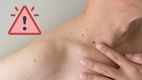 Estas son las mejores técnicas para eliminar verrugas del cuello y cuidar tu piel. (FOTO): Especial.