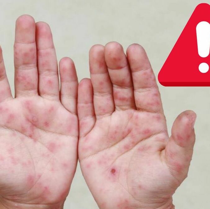 Confirman aumento de casos del virus de coxsackie en México