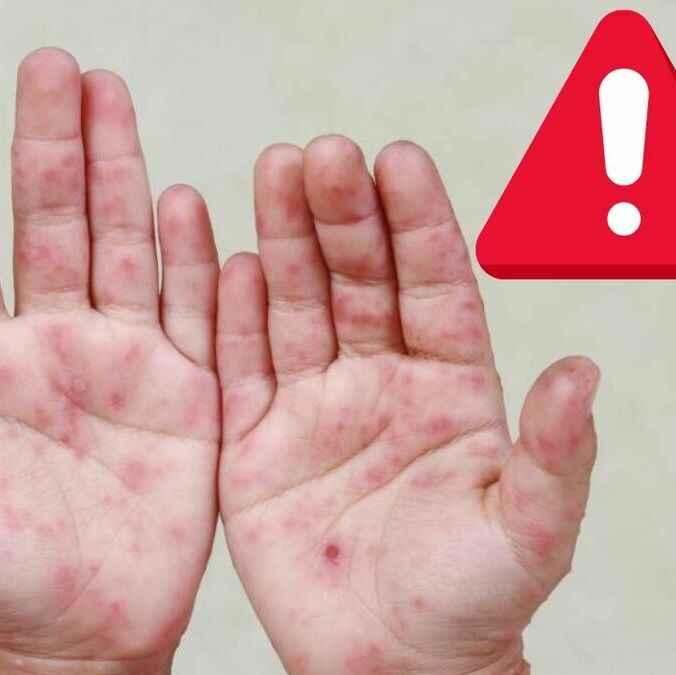 Confirman aumento de casos del virus de coxsackie en México