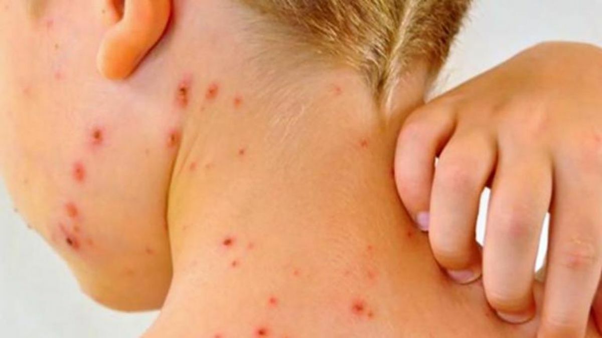 Casos de sarampión en aumento: reportan 1,789 contagios y 5 muertes en México