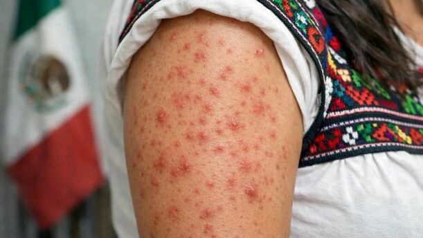 Conoce cómo identificar si ya tuviste sarampión o si ya te aplicaste la vacuna. Foto: Sora IA