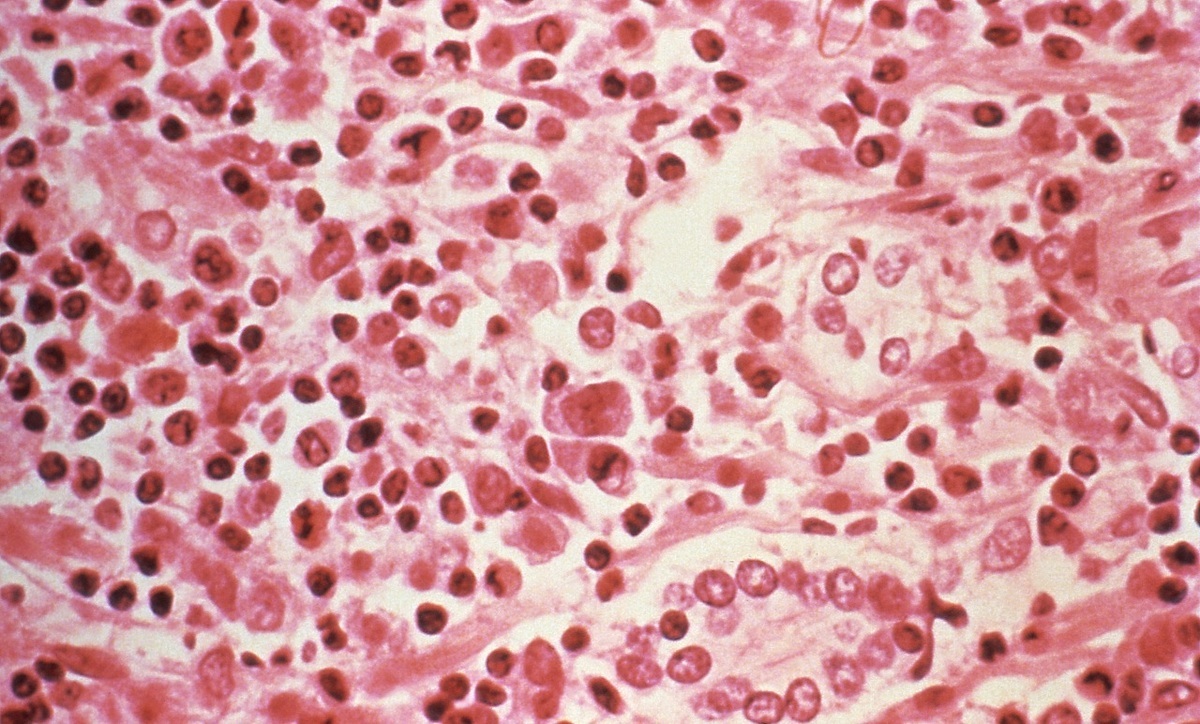 Estudio micrográfico de tejido hepático observado en un caso de síndrome pulmonar por hantavirus (SPH). (Reuters)