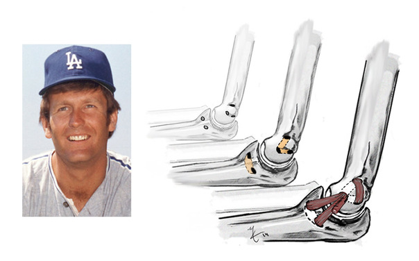 Operación Tommy John, qué es, cuándo se inició, por qué se llama así